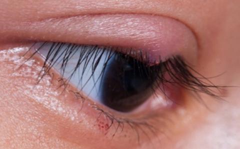 Common Eye Infections Causes and Treatments