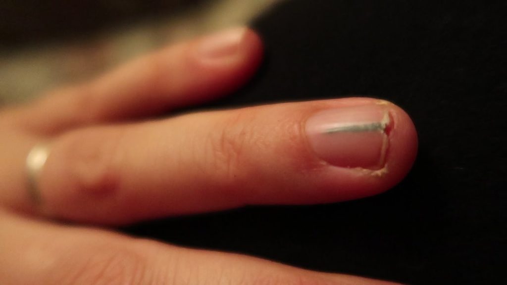 splinter-in-nail (1)
