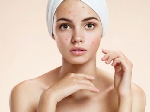 acne skin remedies