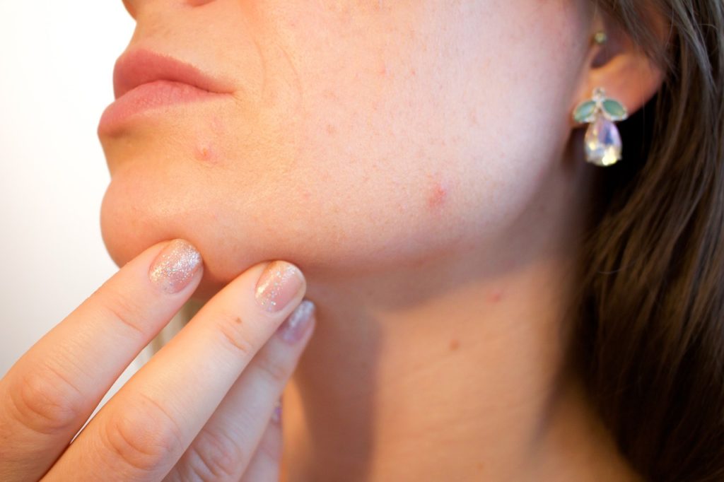 Avoid Acne or Pimple