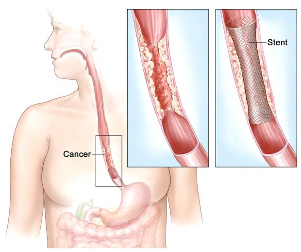Reading the Symptoms of Oesophageal Cancers for Early Diagnosis