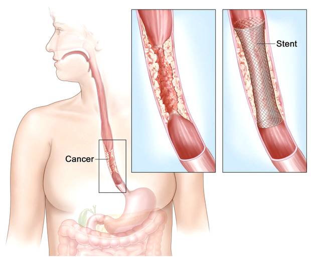 Oesophageal Cancer