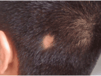 Alopecia Areata: Causes, Symptoms and Diagnosis