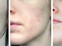 Have You Tried Everything to Treat Acne and Not Getting Any Solution?