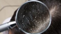 How to Tackle The Dandruff