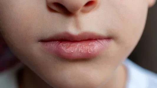 Ways to combat dry skin - your Lips Can Suffer From